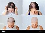 Does Nicolas Roman Strut Have Cancer? Alopecia Universalis Disease & Health Condition