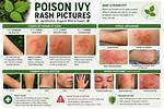 How Long Does Poison Ivy Rash Last?