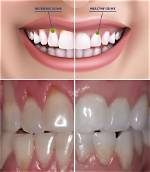 Is It Normal for Gums to Recede Little?