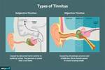 Is Occasional Tinnitus Normal?