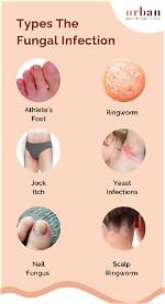 What Does a Fungal Infection on the Skin Look Like?