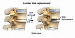 Where Does a Lumbar Disk Replacement Take Place?